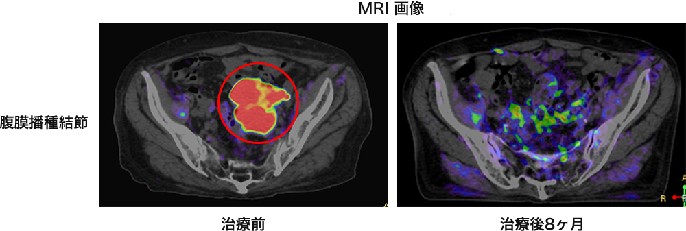 MRI画像